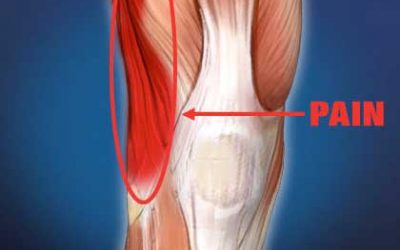 Iliotibial Band Syndrome