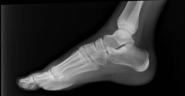 Reducing Risk of Growth Plate Fractures in Youth Climbers