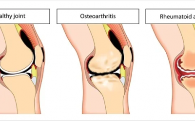 Osteoarthritis Vs Rheumatoid Arthritis